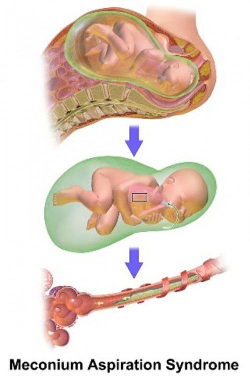 Saya seorang ibu dg anak Mechonium Aspiration Syndrome