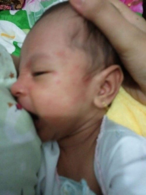 Ruam merah dan bruntusan