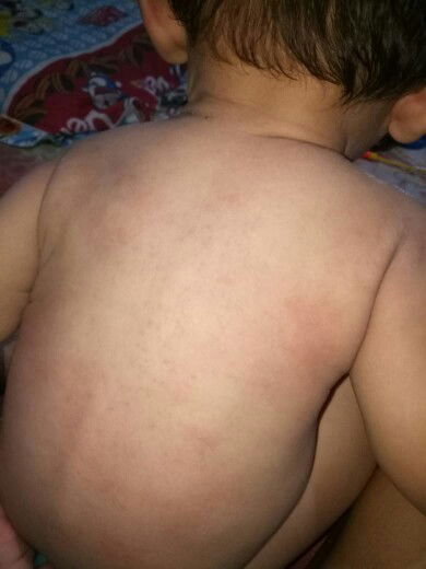 Bintik Merah Di Anak