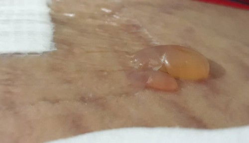 benjolan pasca op caesar