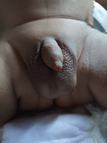 Kemerahan di hujung penis bayi lelaki