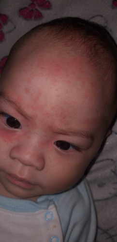 Rashes
