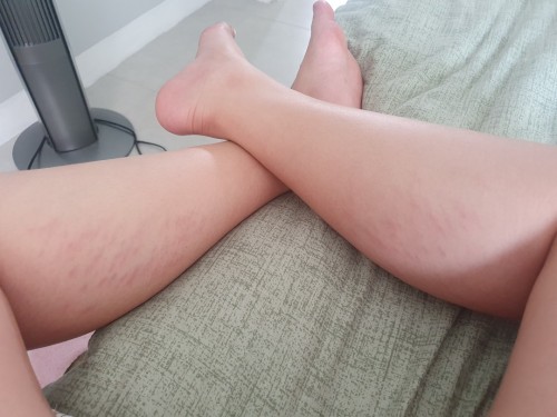 Stretch marks behind legs