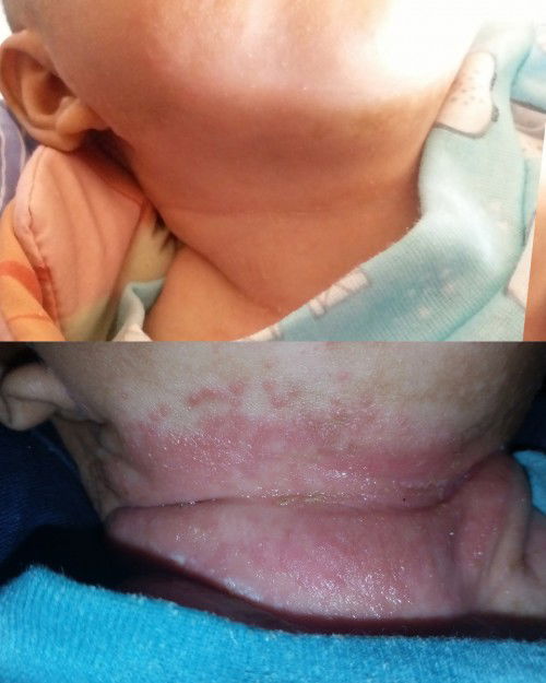 Pulih gatal lehernya