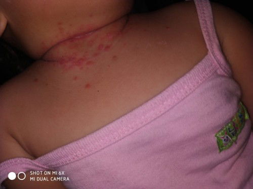 Gatal di leher balita