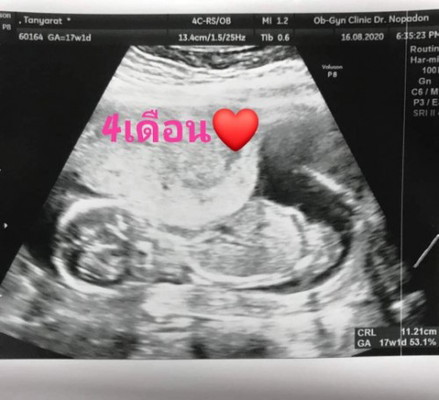 คุณหมอบอกลูกสาว80%ค่ะ❤️