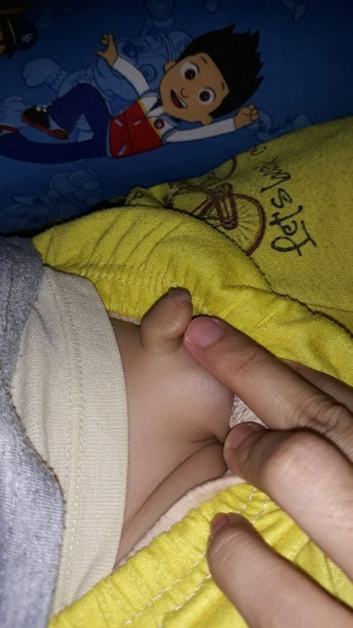 benjolan dikepala penis