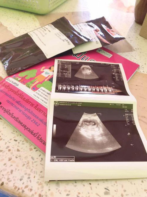 อัลตร้าซาวน์ที่เห็นน้องดิ้น