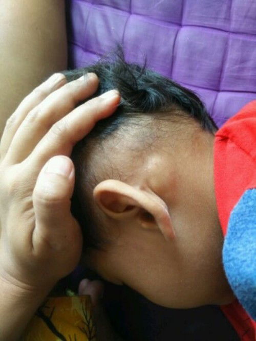 benjolan belakang telinga