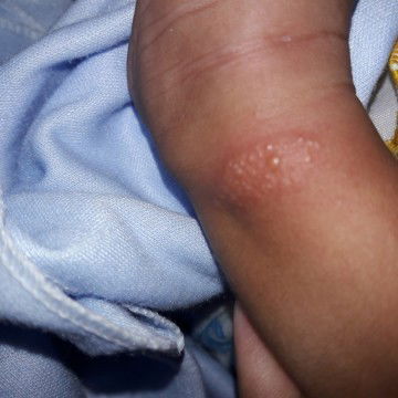 badan brubtusan berair