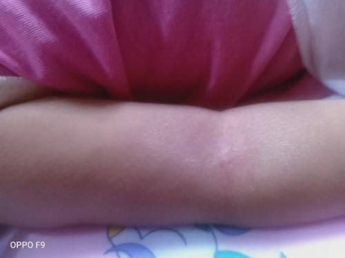 rash