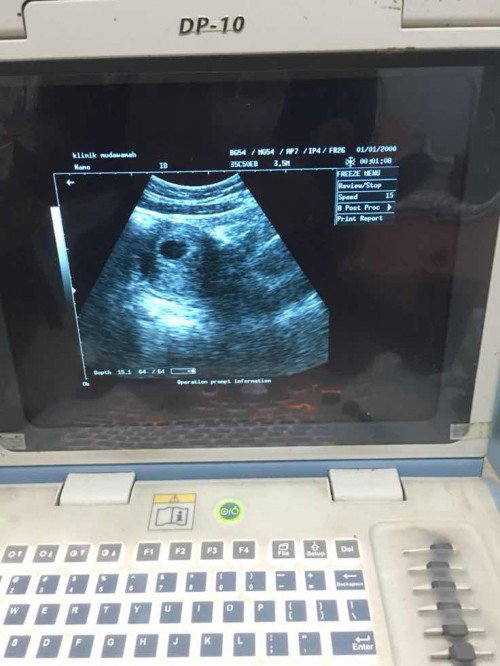 Usia kehamilan 7 minggu
