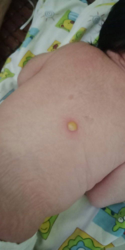 Mọc nhọt ở lưng