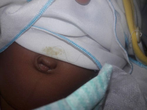 PUSER KELUAR DAGING LUNAK