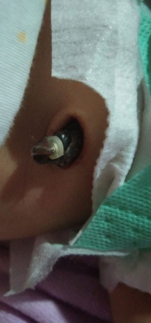 สะดือน้องเป้นแบบนี้จะหลุดเองไหมค่ะ