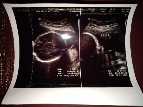 Kehamilan kedua setelah caesar