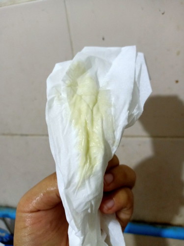ตกขาวเป็นแบบนี้อันตรายไหมคะ