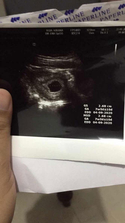 Divonis BO pada kehamilan pertamaku