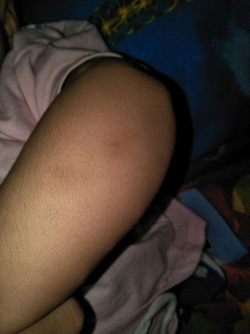 bekas gigitan nyamuk