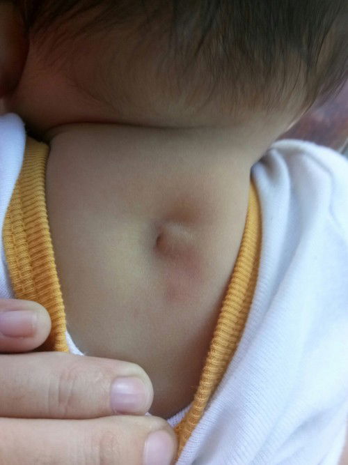 Congenital dermal sinus