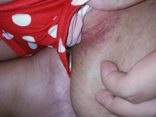 yeast infection?