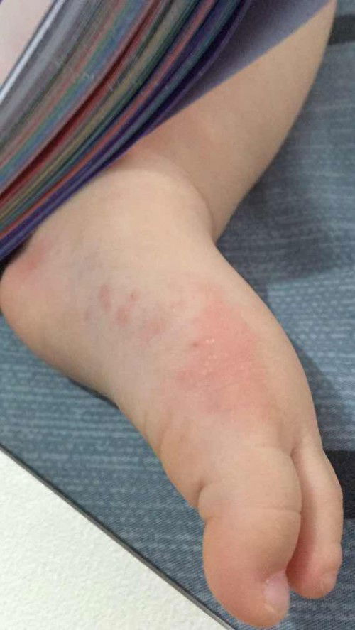 bentol berair di kaki anak