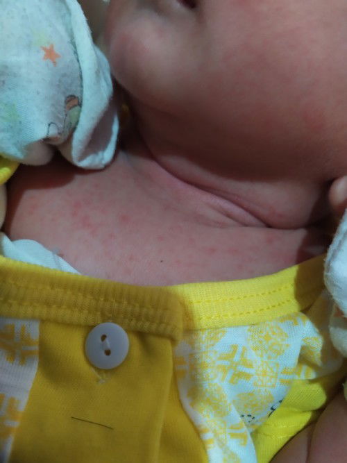 Kulit bayi merah merah