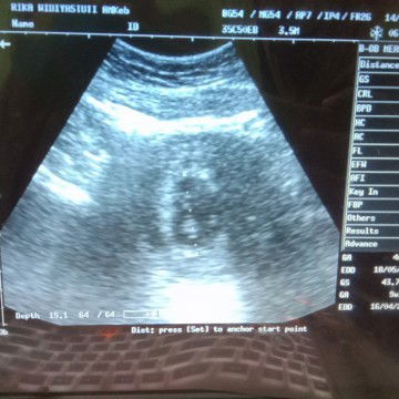 uk hpht dan usg beda