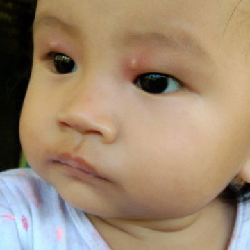 Akibat gigitan nyamuk