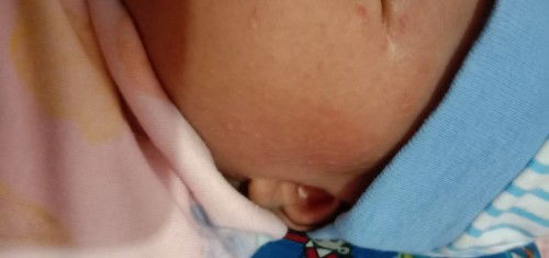 Muka baby bintik2 merah