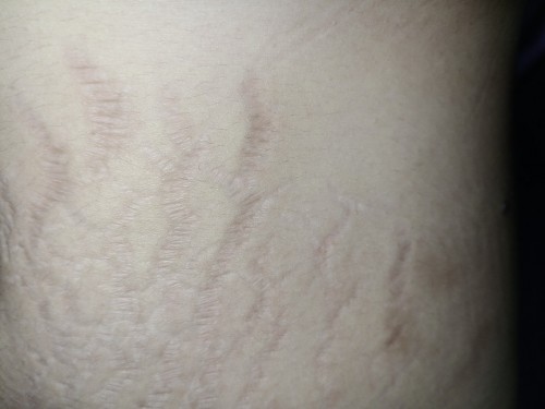 แผลเป็นที่ไม่อยากเป็น..!!!