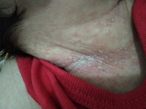 tumbuh bintik" pd anak