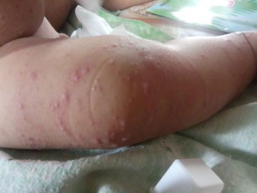 Apakah ini cacar air