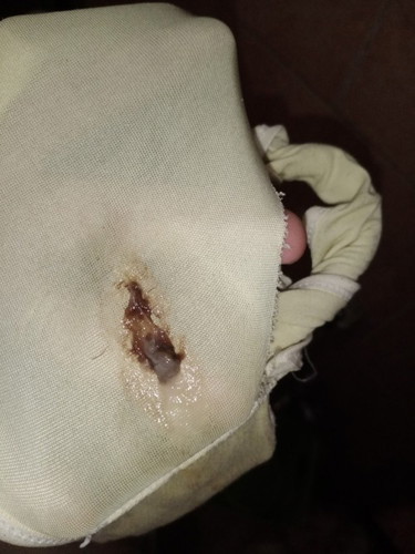 Mucus plug