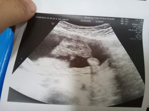 ซาวด์ตอน18w2d