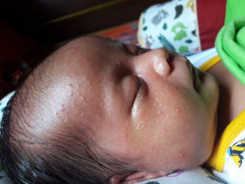 Mungka bayi yg bintik2