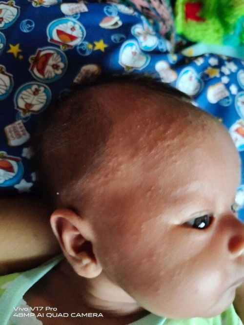 Cara menghilangkan beruntusan