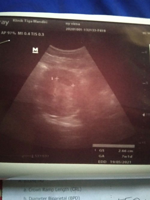 Mohon sarannya Bun tentang USG, lagi worry banget nih