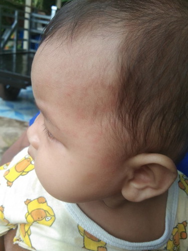 เป็มตุ่มสีแดง