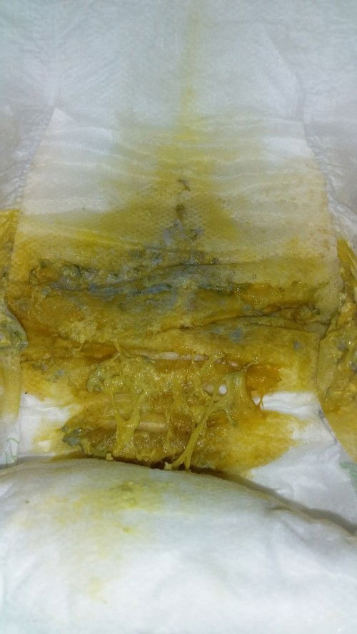 poop abu abu setelah imunisasi