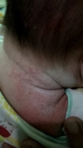 Leher belakang bayi bruntusan