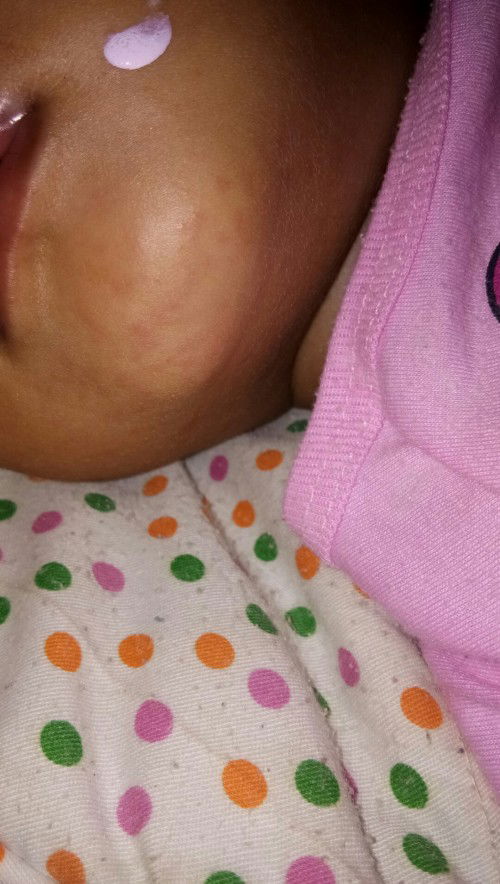 Bintik merah pada kulit anak