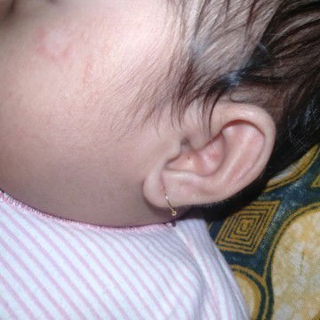 Merah merah di wajah bayi