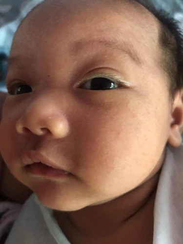 ผดผื่นขึ้นที่ใบหน้า