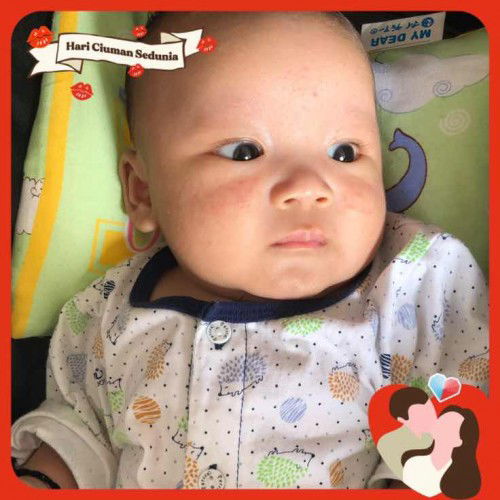 Jerawat pada muka baby