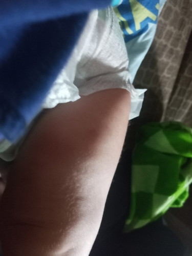 namaga ang hita ni baby