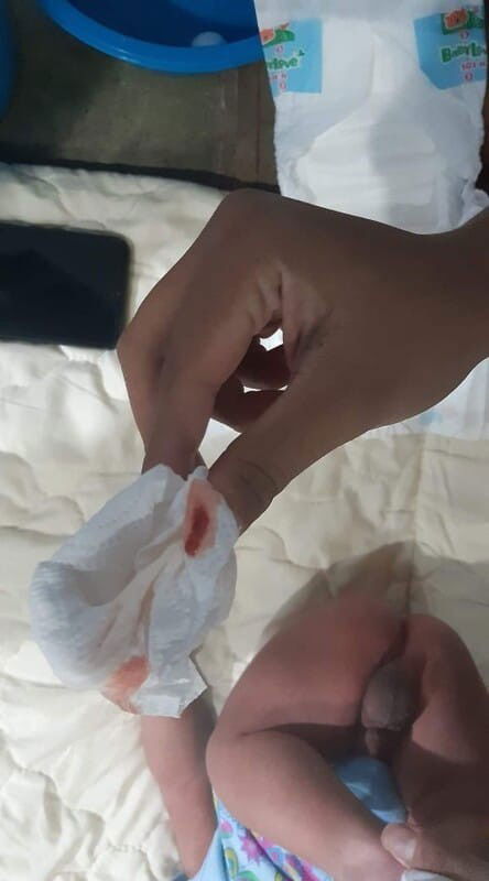 ถ่ายมีเลือด