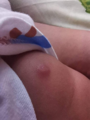 Insect bite
