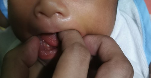 Epstein pearl po ba to?