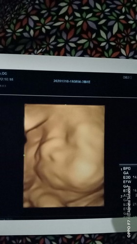 Hasil usg 31 week